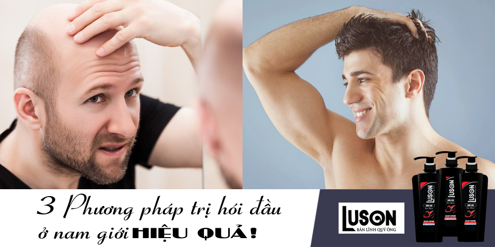 trị hói đầu cho nam giới